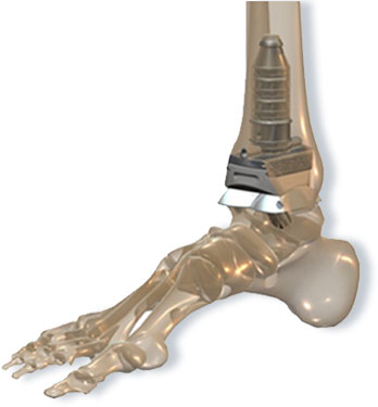 INBONE™ Total Ankle System - Total Ankle Institute